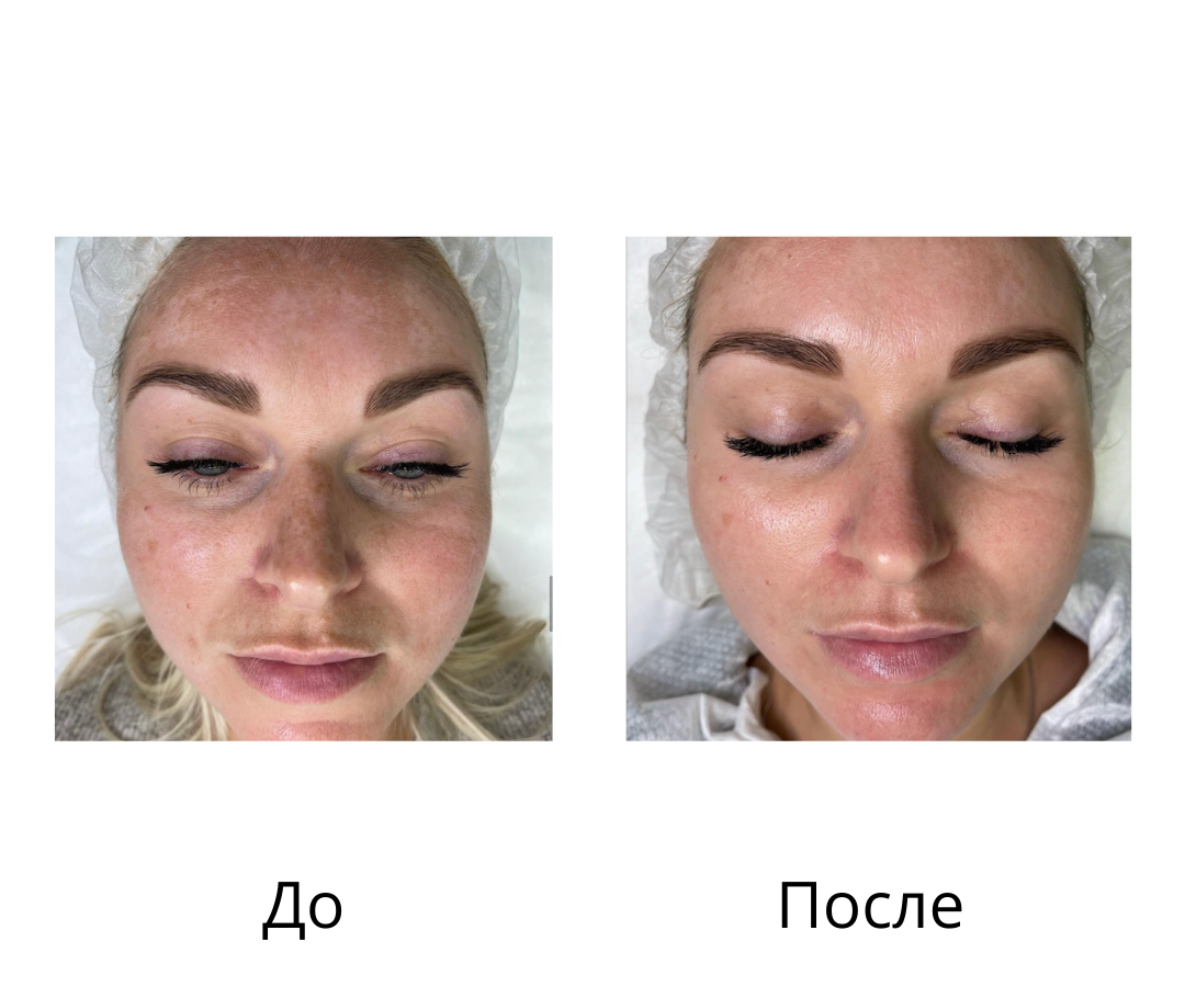 ViPeel Chemical Skin Peel Orange County - Irvine, CA - Dr. Nissan Pilest Skin tr