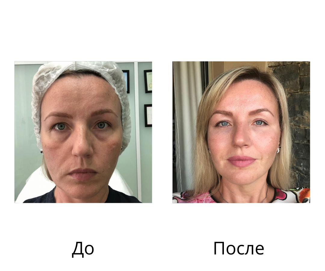 Коррекция носослезной борозды - Пасихат Батировна