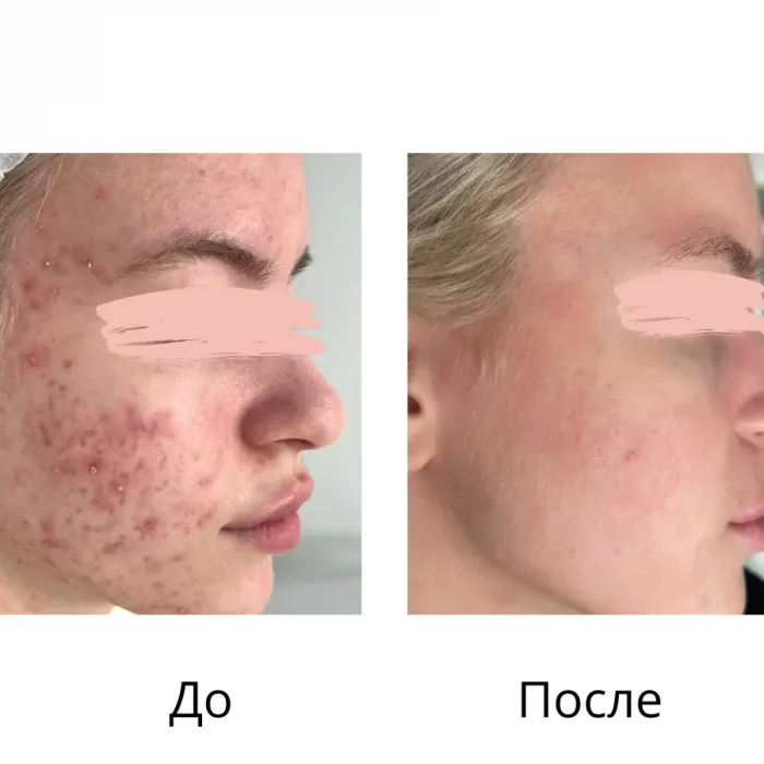 Комплексное лечение акне - Осколкова Анастасия