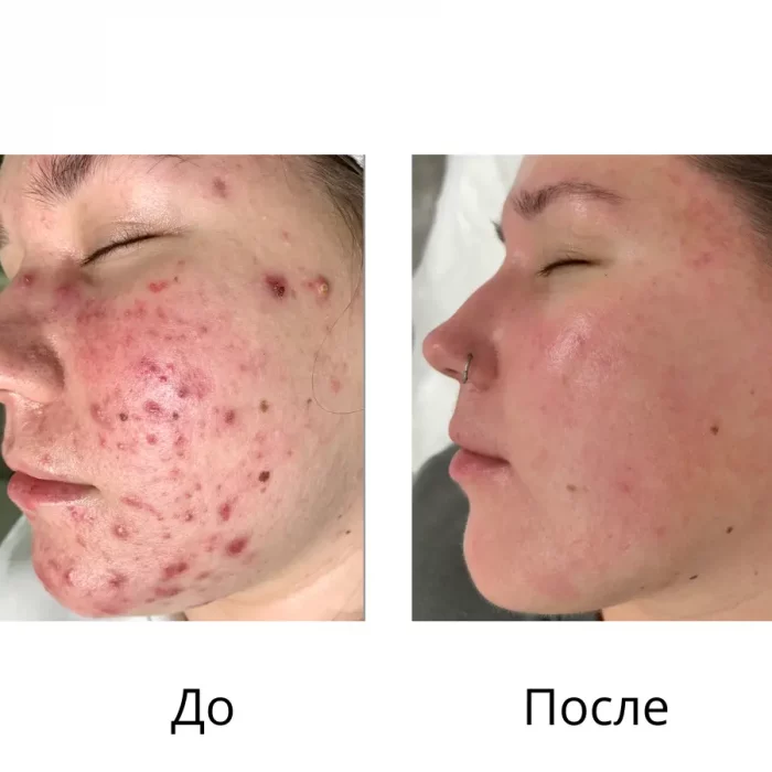 Комплексное лечение акне - Осколкова Анастасия