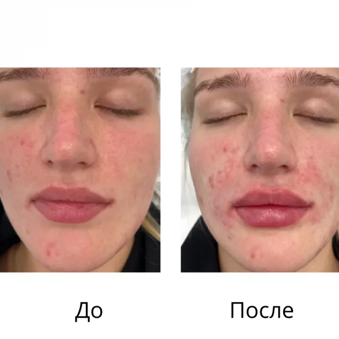 Контурная пластика губ - Осколкова Анастасия