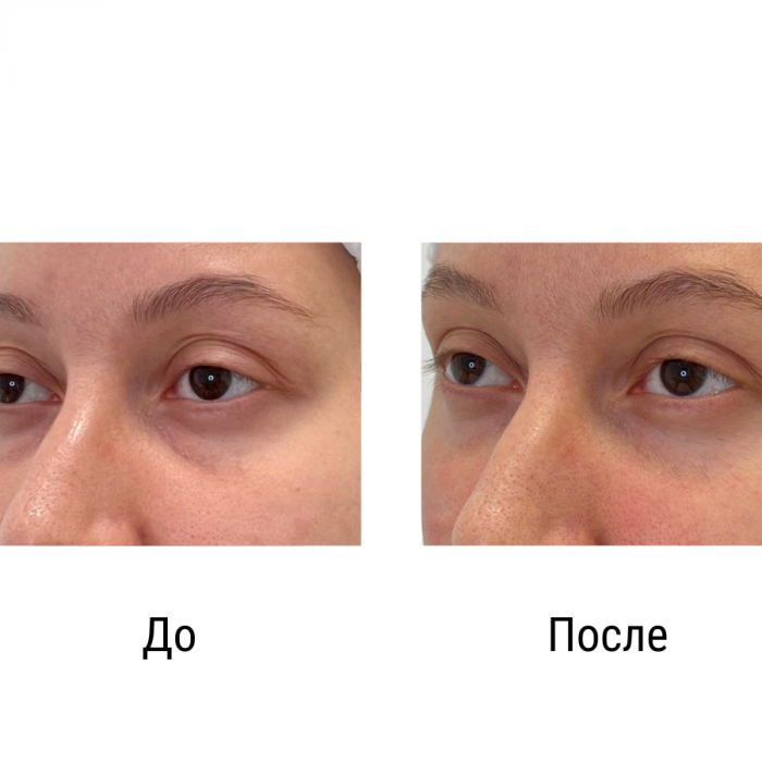 Коррекция носослезной борозды - Осколкова Анастасия
