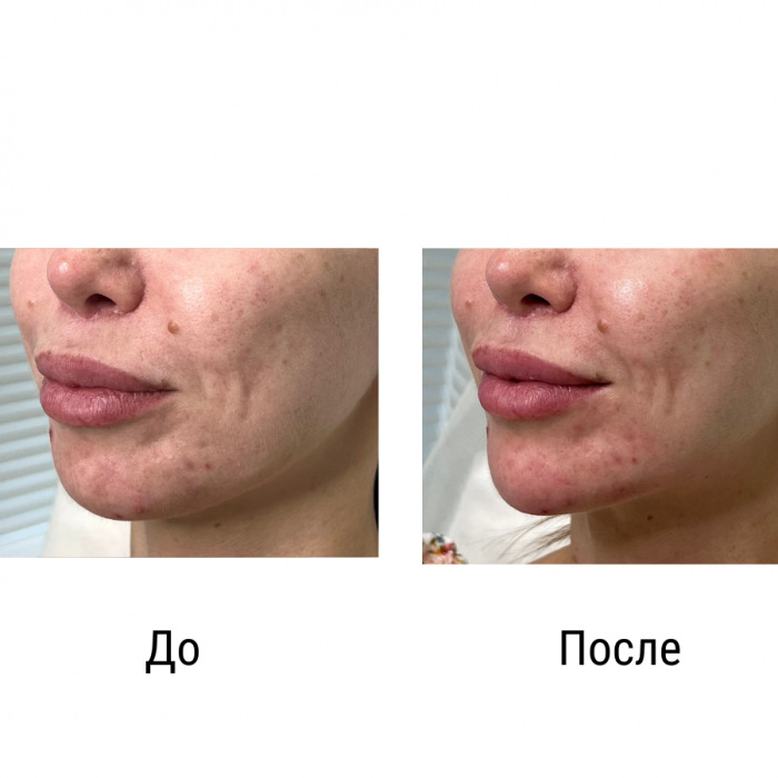 Объемное моделирование подбородка - Осколкова Анастасия