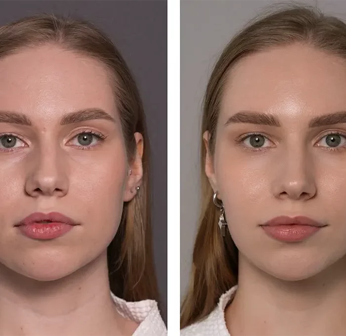 Комплексная работа( ультраформер, заполнение носослезных борозд, ботулинотерапия  - Осколкова Анастасия