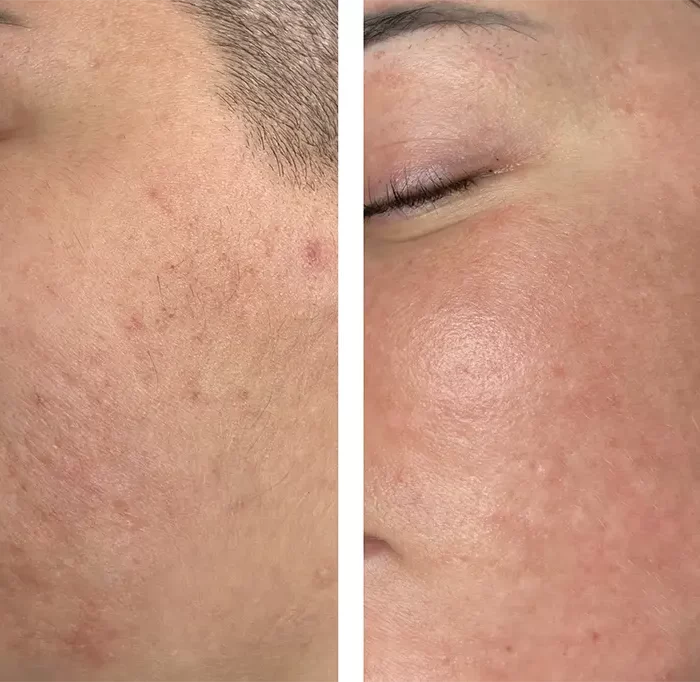 Лазерная  шлифовка - Осколкова Анастасия