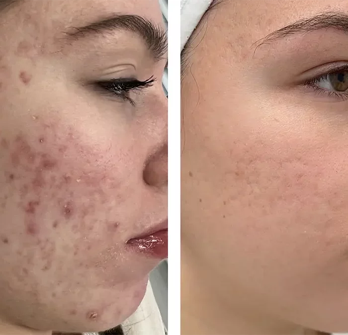 Лечение постакне  - Осколкова Анастасия