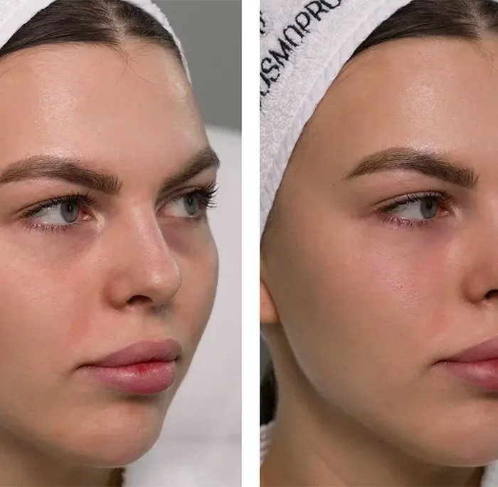 Заполнение носослезной борозды  - Осколкова Анастасия