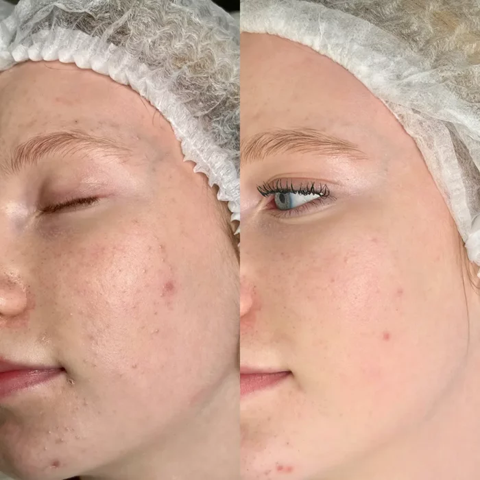 Чистка, пилинг, ФДТ