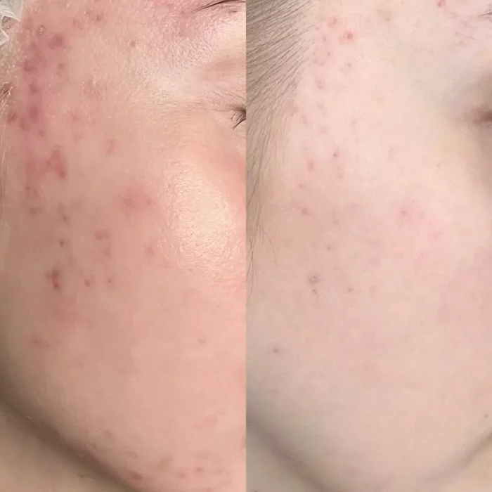 Комплекс процедур (чистка, BBL, сосудистый лазер)