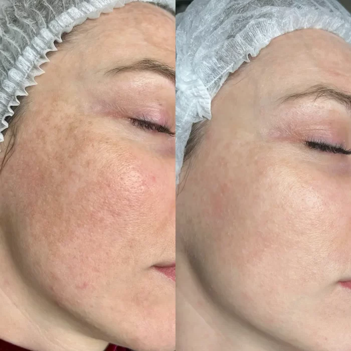 3 процедуры BBL