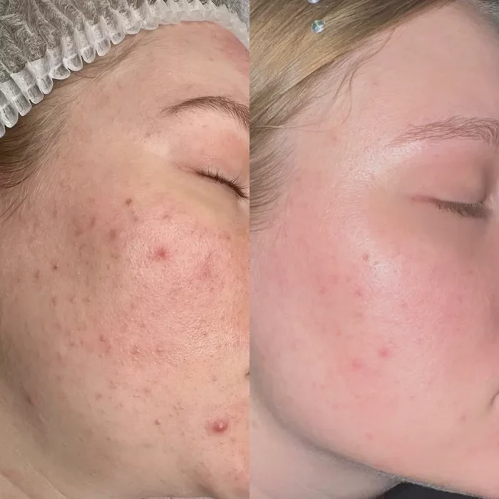 2 чистки, лазер анти акне и плазматерапия