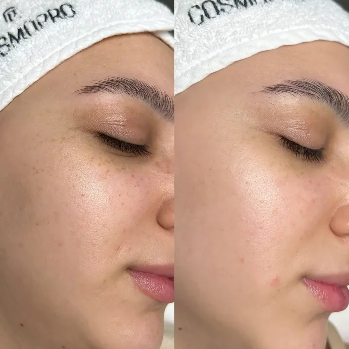 2 процедуры BBL