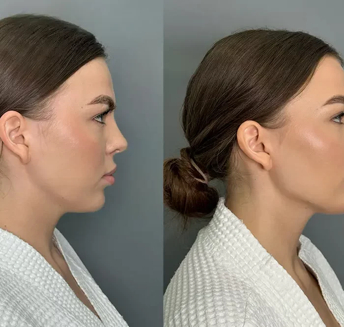 Контурная пластика