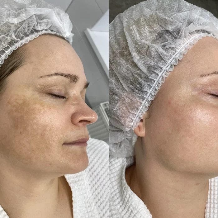 Работа с пигментацией