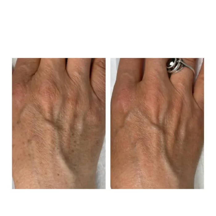 BBL 2 процедуры