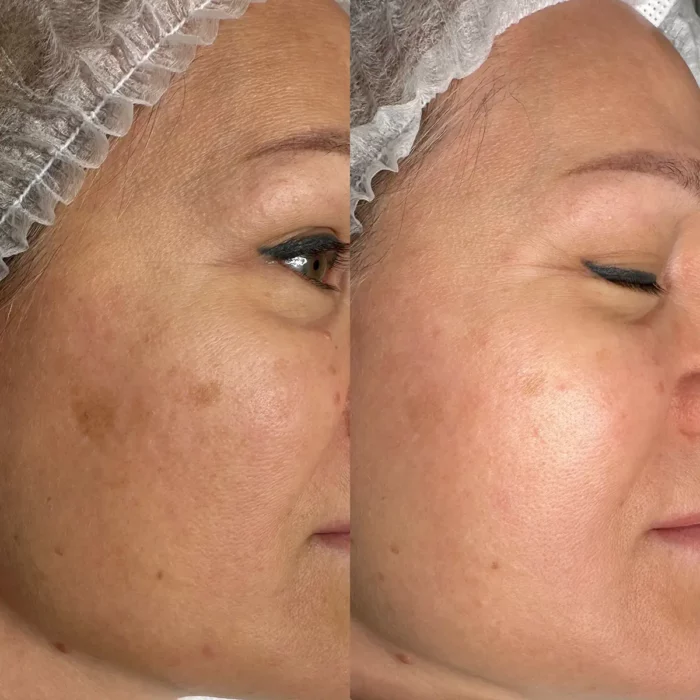 BBL три процедура