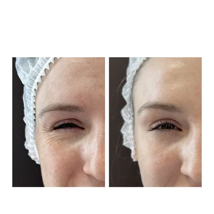 Ботулинотерапия