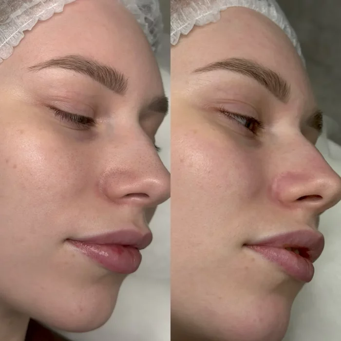 Чистка лица