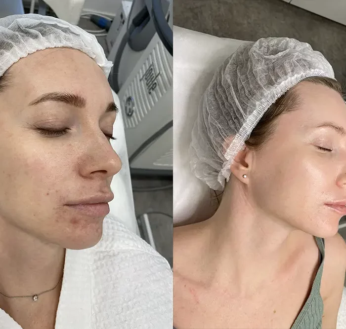 Лазерное лечение акне