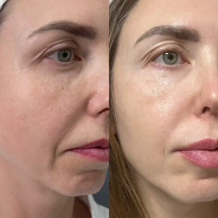 Комплекс процедур (bbl, пилинг, биоревитализация)