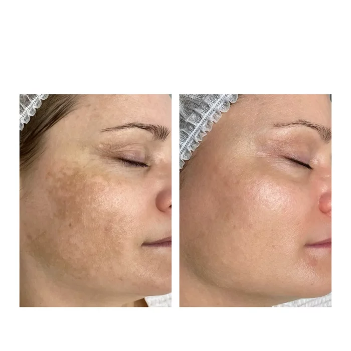 Комплексная терапия (пигментация)