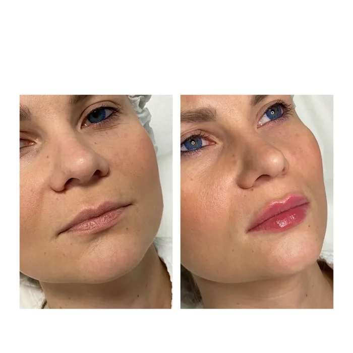 Контурная пластика губ