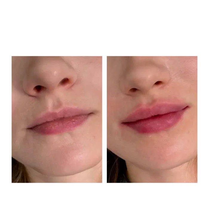 Контурная пластика губ