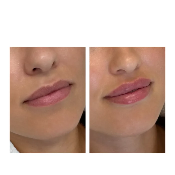 Контурная пластика губ