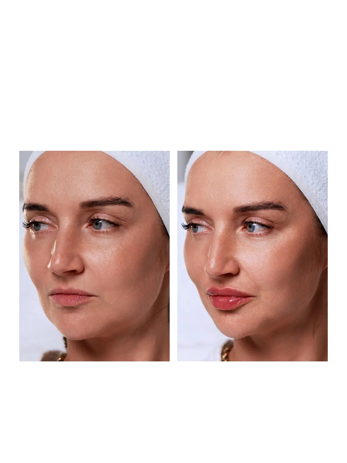 Контурная пластика губ