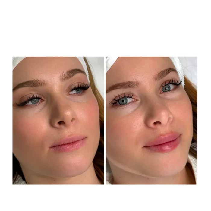 Контурная пластика губ