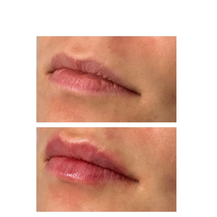 Контурная пластика губ