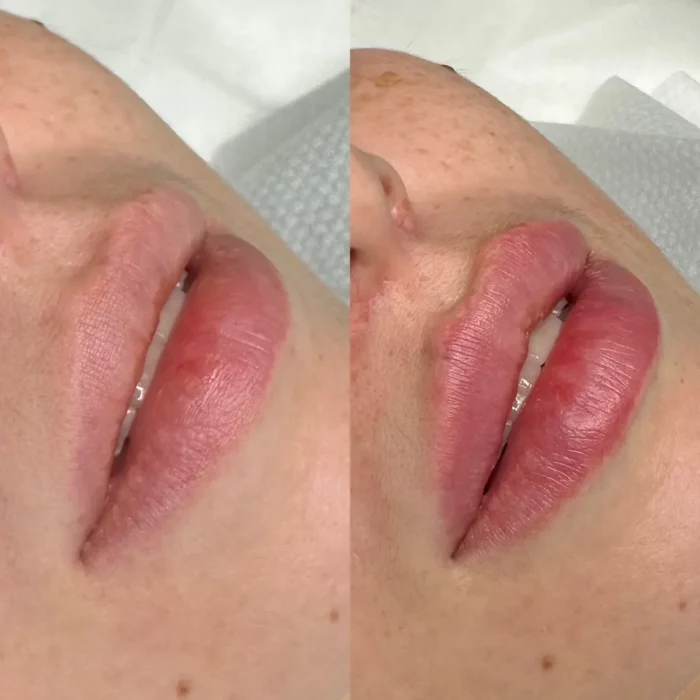 Контурная пластика губ