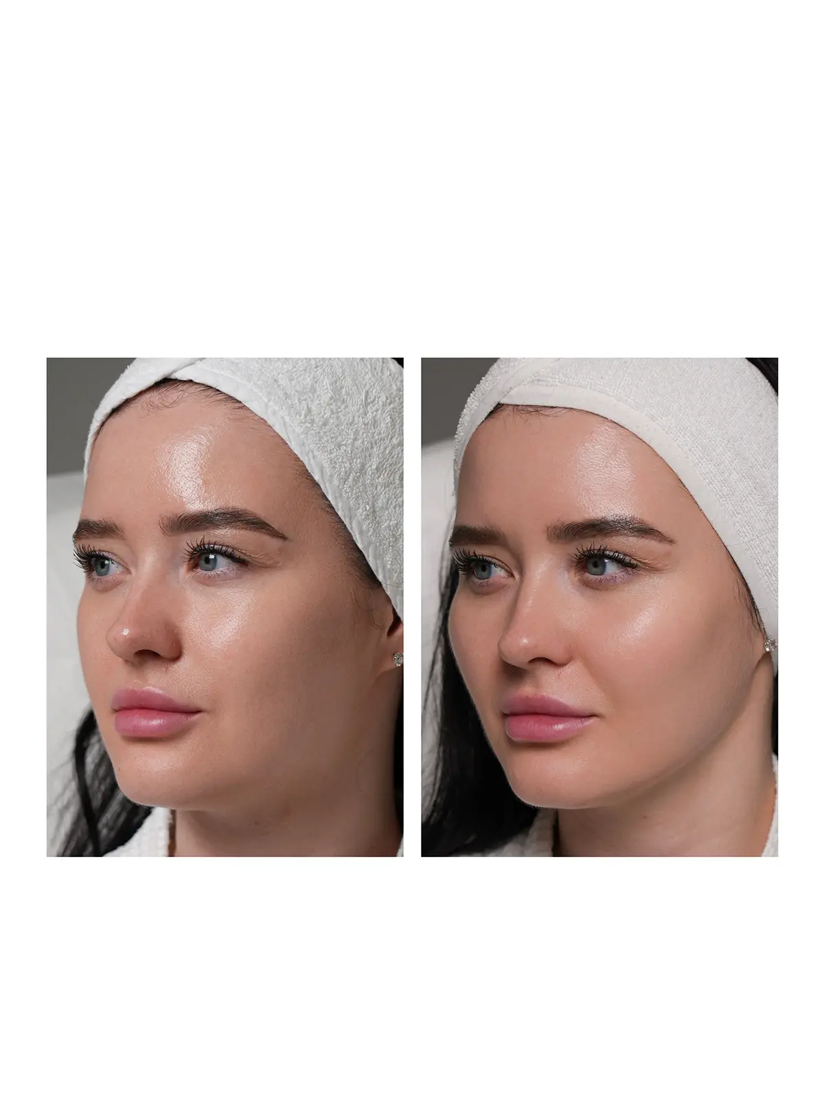 Контурная пластика лица