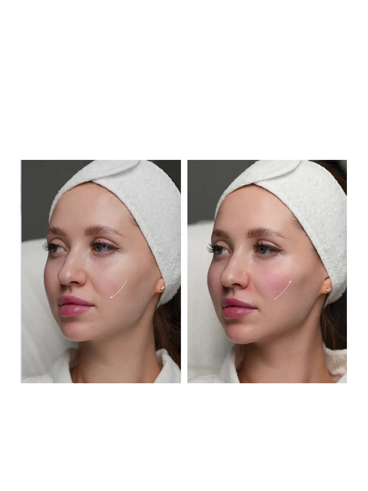 Контурная пластика лица