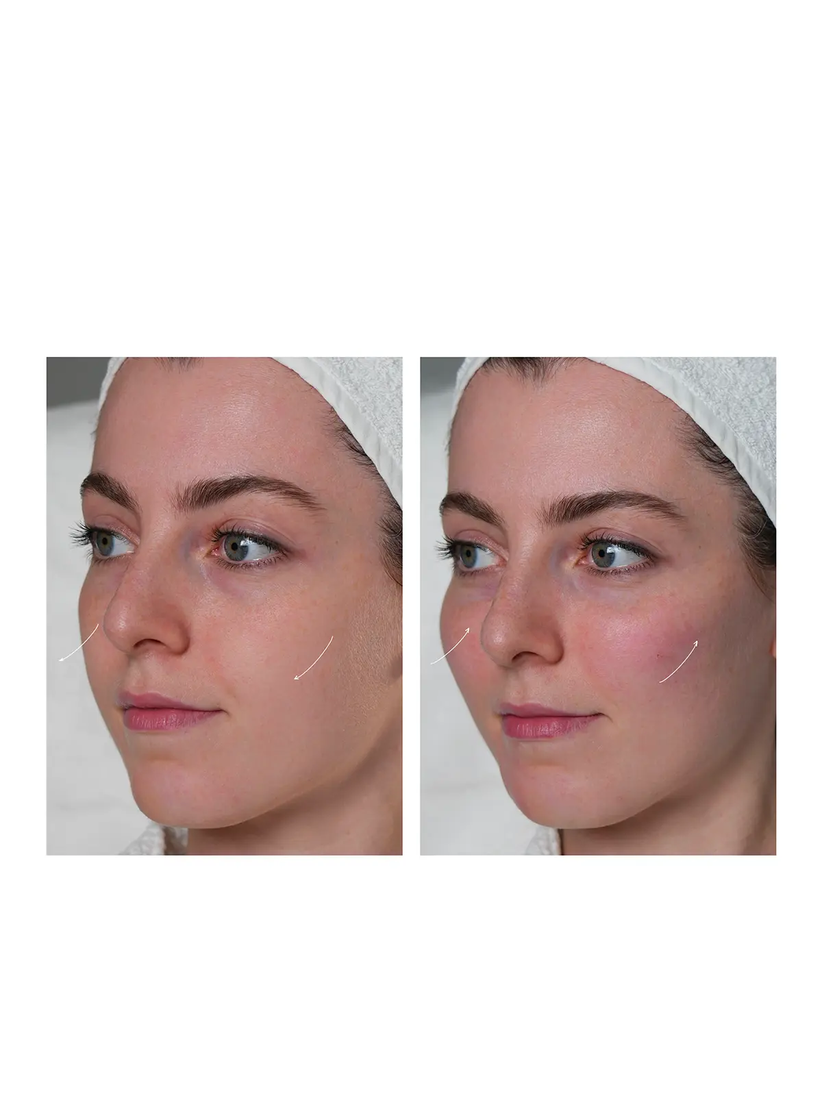 Контурная пластика лица