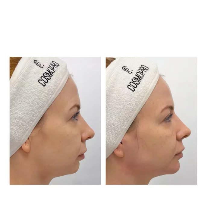 Контурная пластика нижней трети