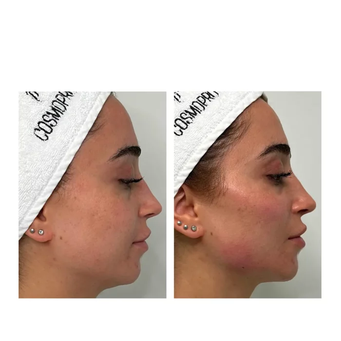 Контурная пластика радиес