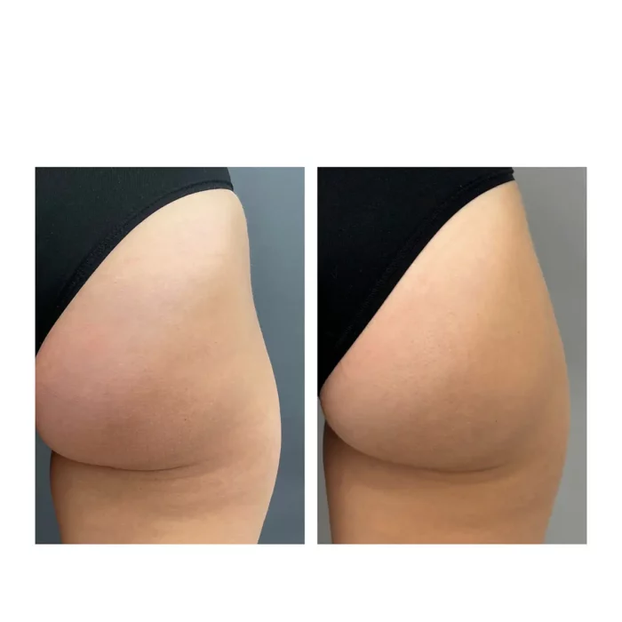 Контурная пластика ягодиц