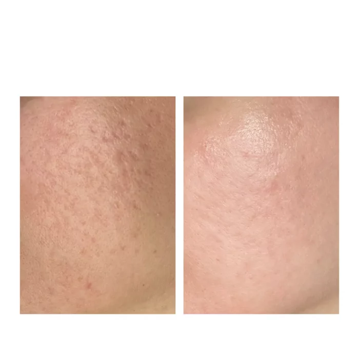 Лазерная шлифовка