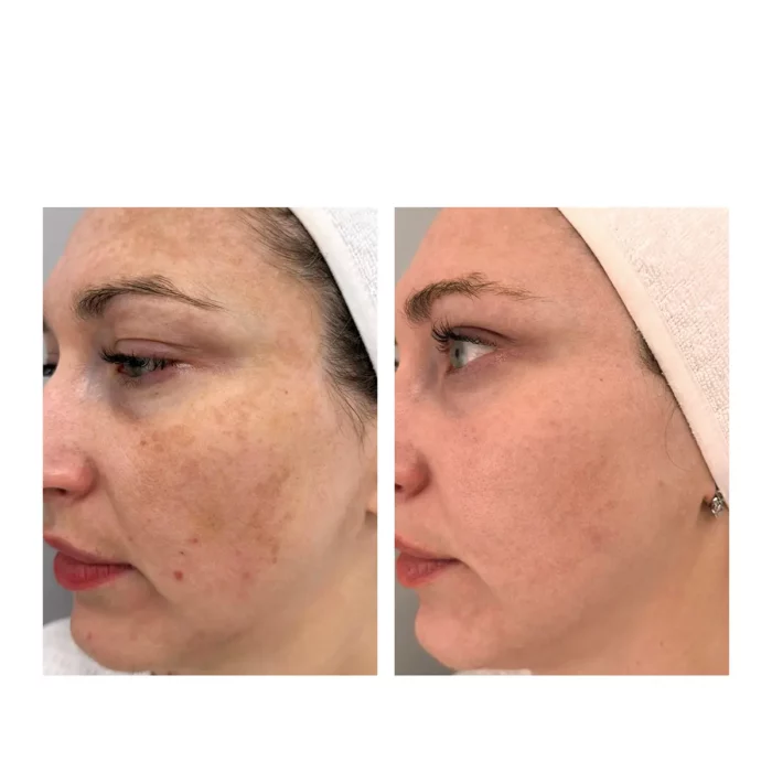 Лазерная шлифовка