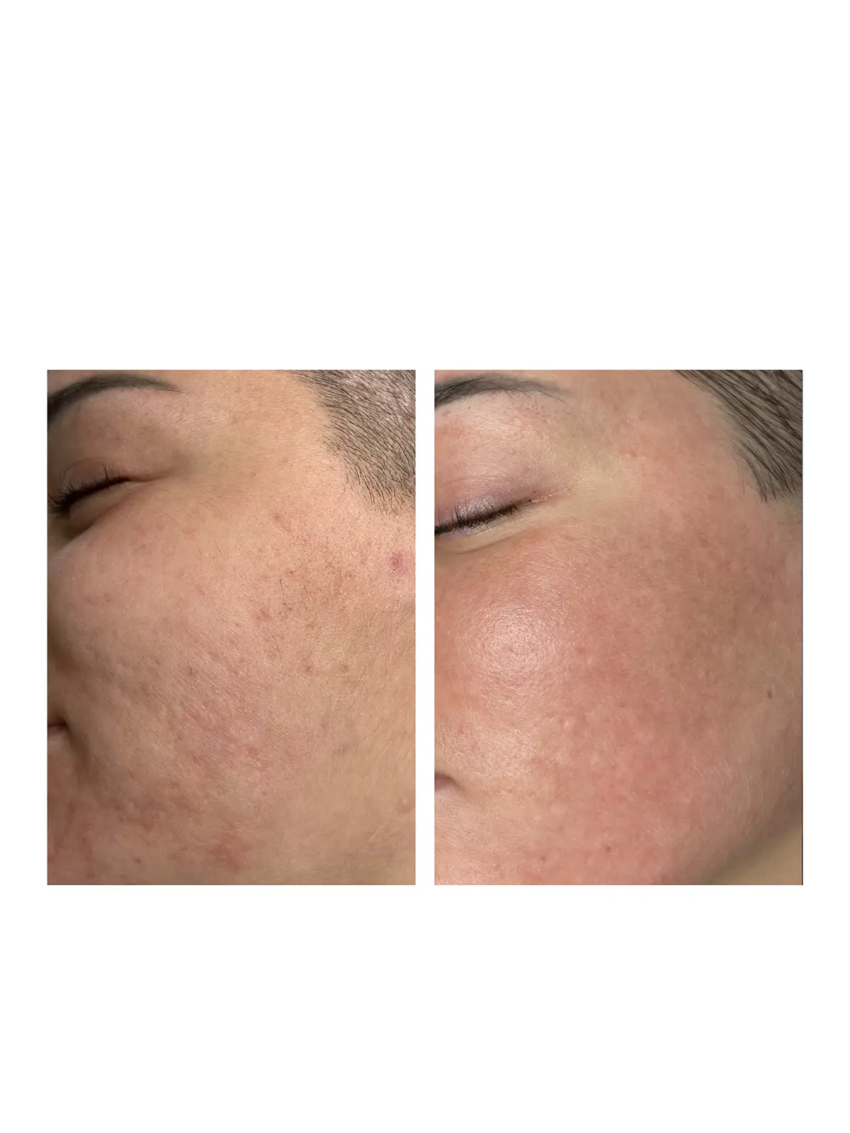 Лазерная шлифовка