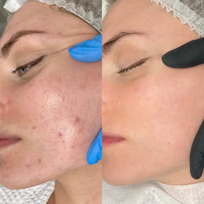 Лечение акне