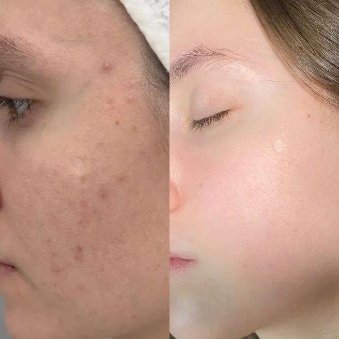 Лечение акне