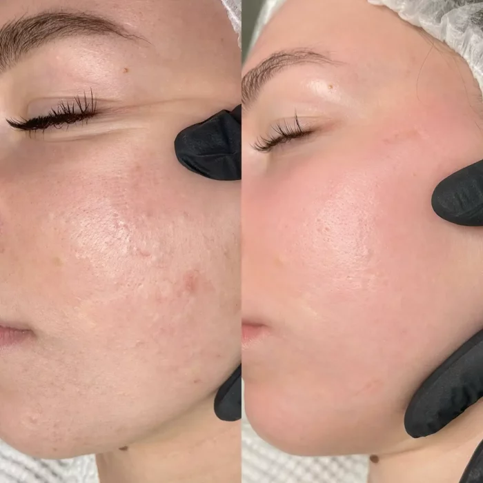 Лечение акне