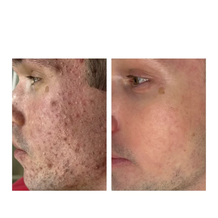 Лечение акне