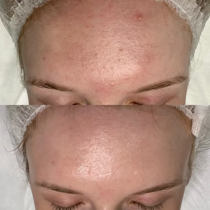 Лечение акне (наружная терапия) и ботулинотеарпия лба