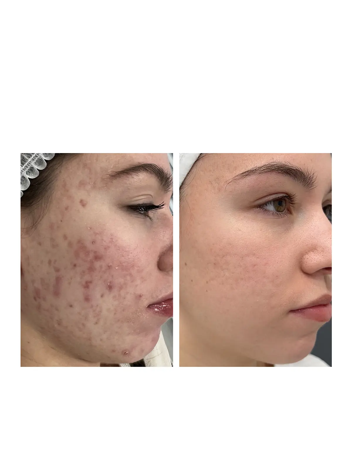 Лечение акне