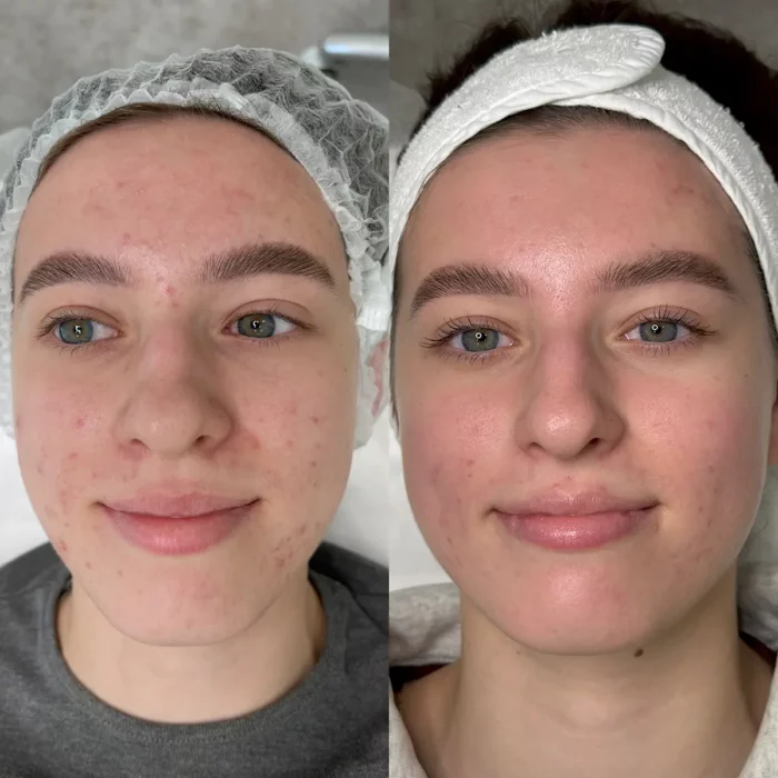 Лечение акне (промежуточный результат)