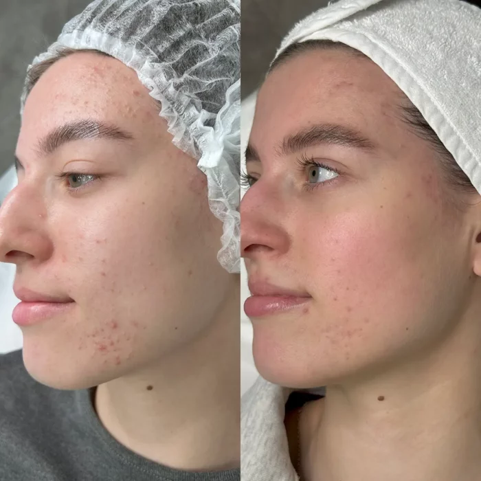 Лечение акне (промежуточный результат)
