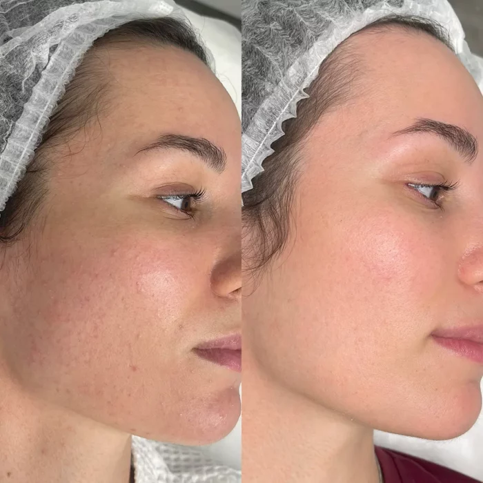 Лечение фолликулита